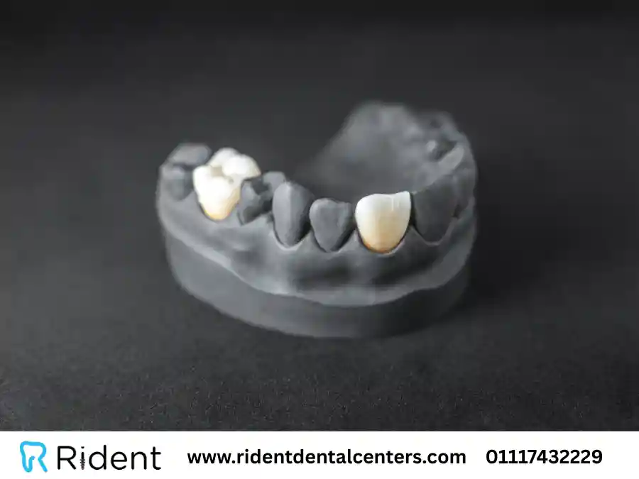 اسعار كراون الاسنان